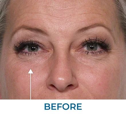 Michael before using Rapid Reduction Serum