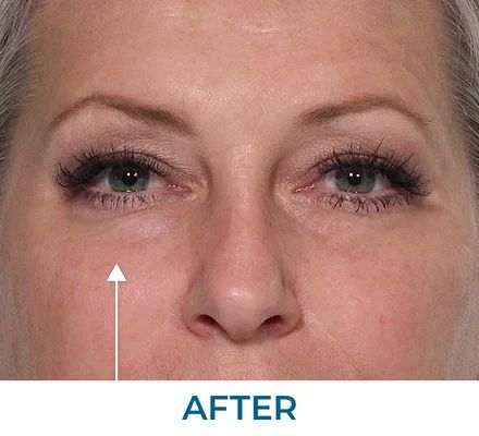 Michael after using Rapid Reduction Serum