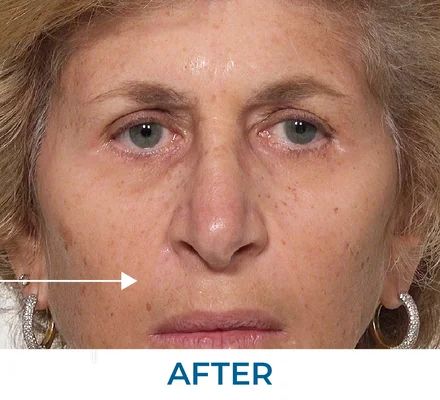 James after using Rapid Reduction Serum