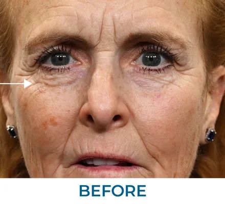 Robert before using Rapid Reduction Serum