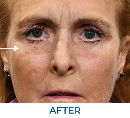 Robert after using Rapid Reduction Serum
