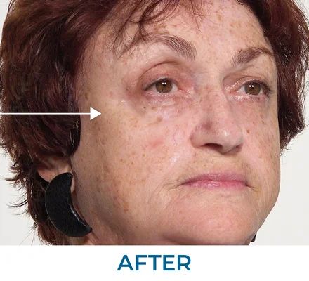 William before using Rapid Reduction Serum