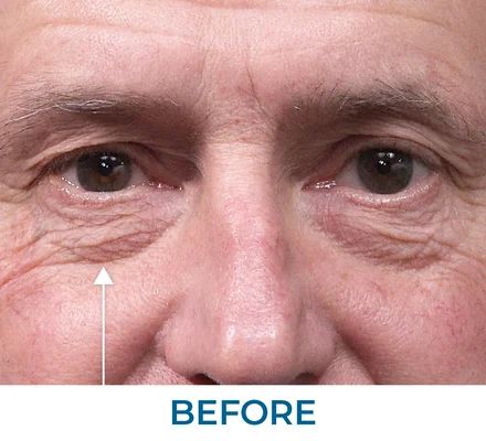 Barbara before using Rapid Reduction Serum