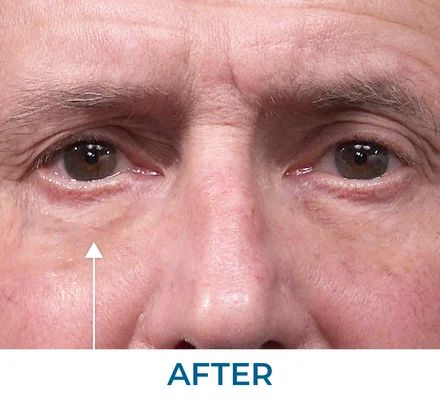 Barbara after using Rapid Reduction Serum
