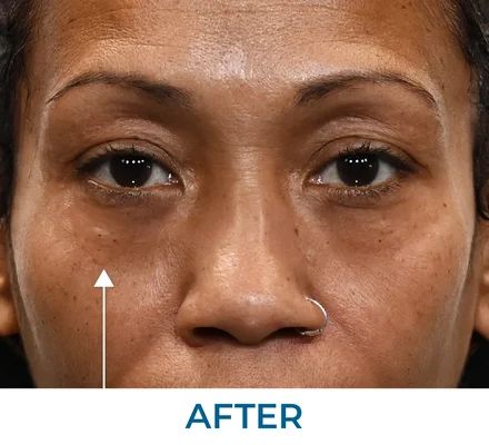 Ritchie after using Rapid Reduction Serum