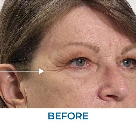 Deborah before using Rapid Reduction Serum